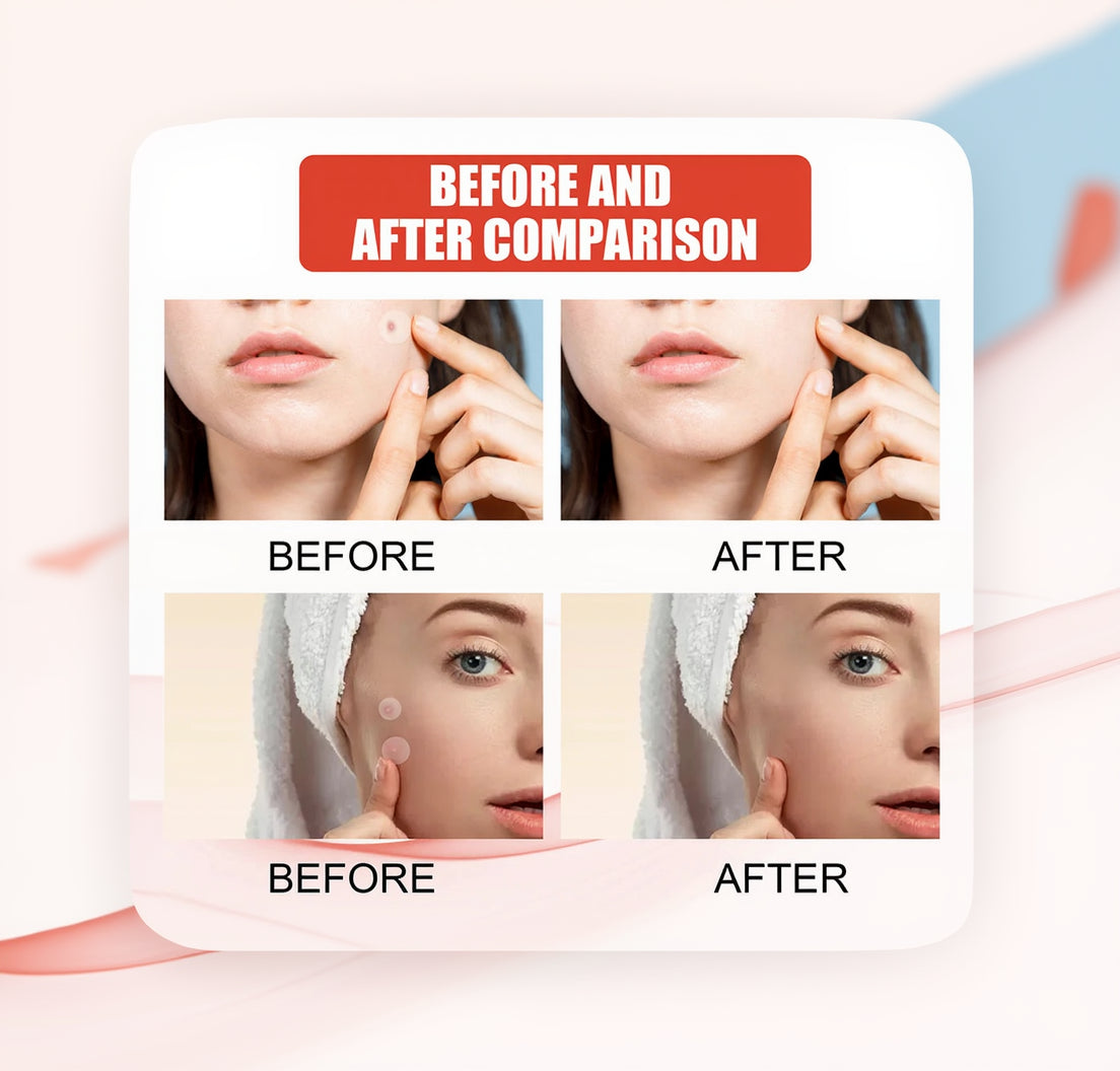 Mağazam acne healing patches in a clear packaging, showcasing the circular, translucent patches for blemish treatment.