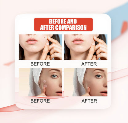 Mağazam acne healing patches in a clear packaging, showcasing the circular, translucent patches for blemish treatment.